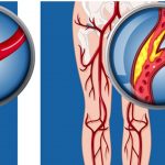 The Cause of Vascular Disease and How to Reduce the Symptoms